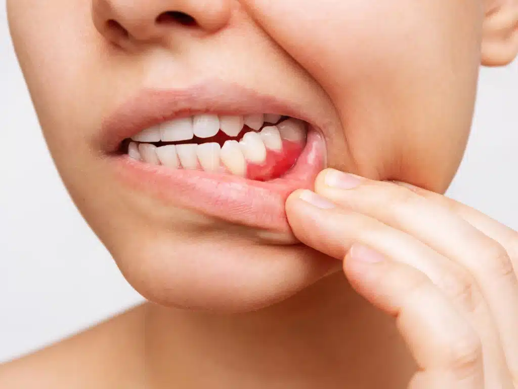 Gums Under Attack: A Guide to Combating Gums  Problem in Ottawa