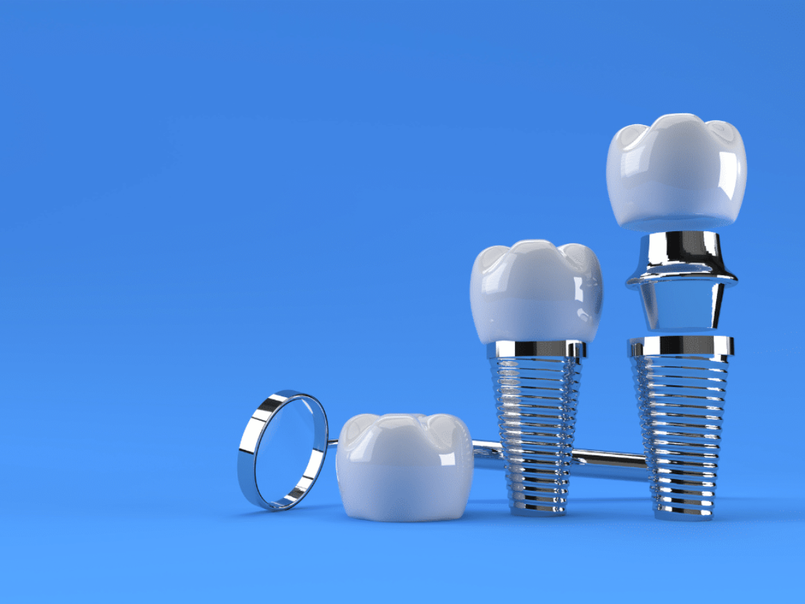 Dental Implants: A Permanent Solution for Missing Teeth in Ottawa