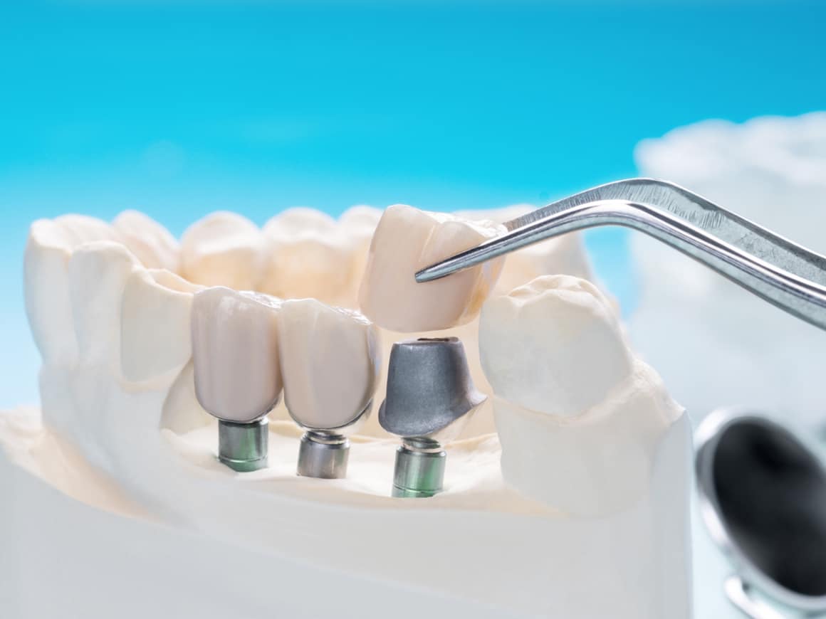 Dental Implants in Ottawa: A Guide to Replacing Missing Teeth