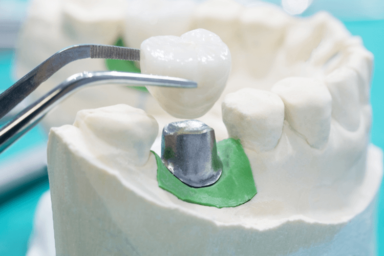 demonstration of the teeth implantation on the white colored jaw model