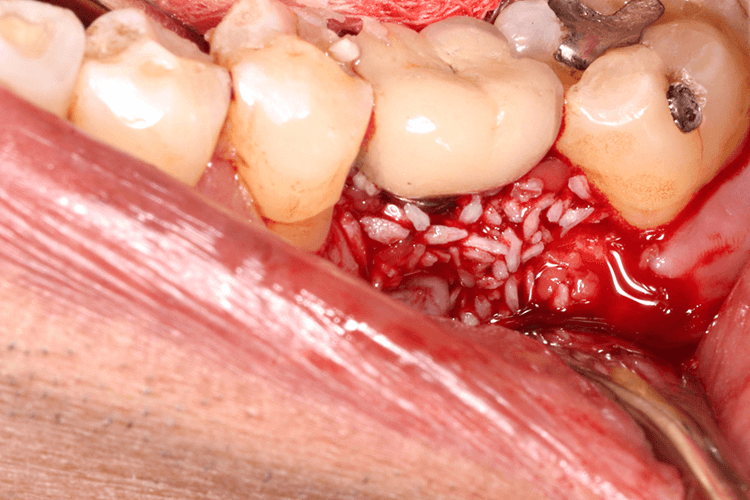 Close up of the blood coming out of the bad gums