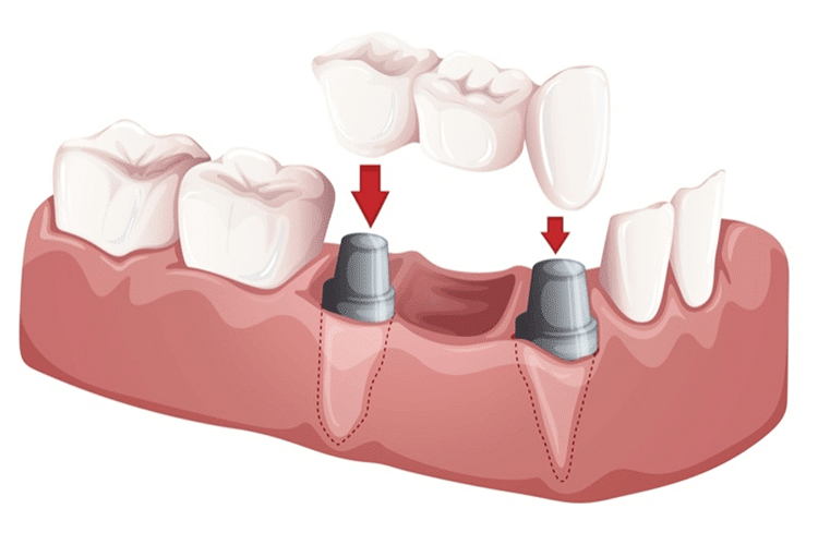 3d graphic illustration of bridge implantation