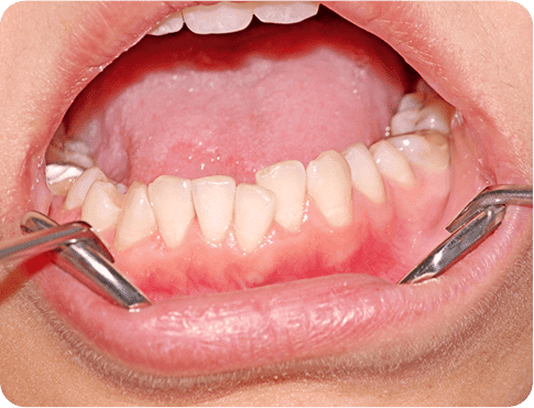 Closeup of the mouth having gum problem