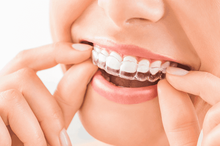5_invisalign 5_invisalign