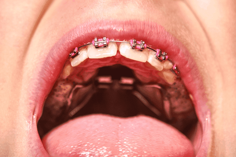 6_functional-jaw-orthopedics 6_functional-jaw-orthopedics