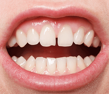 6_gap_between_teeth 6_gap_between_teeth