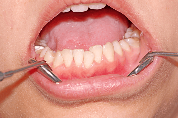 7_gum-problems 7_gum-problems