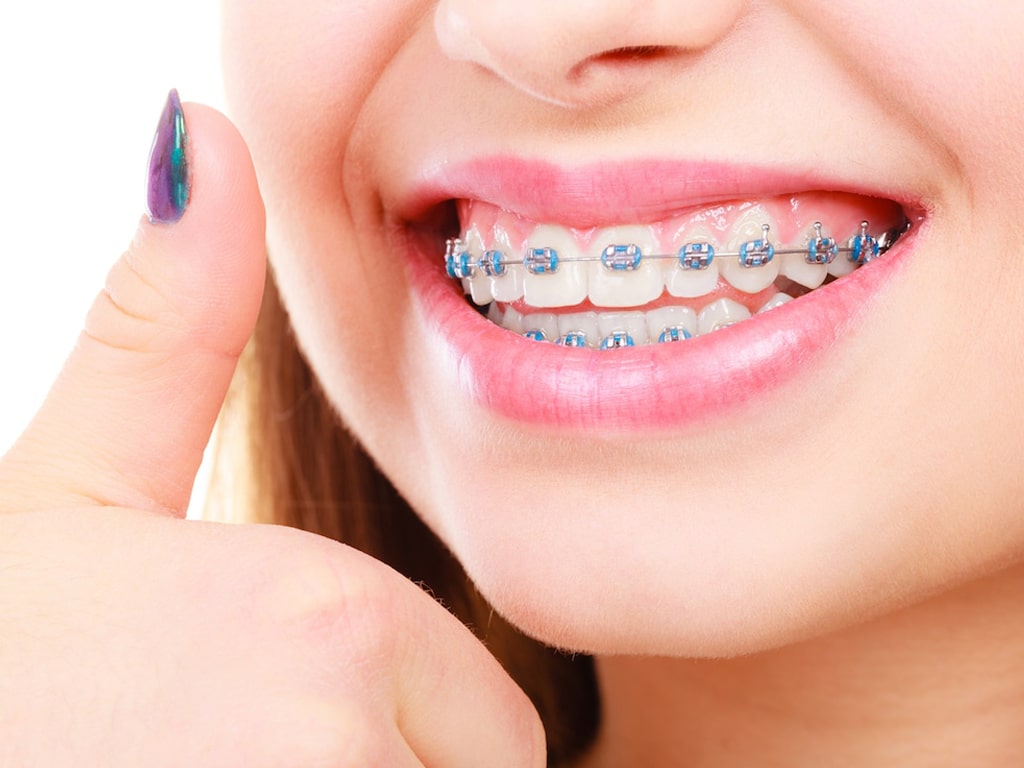 Crooked Teeth