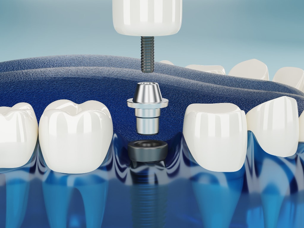 Why Choose Our Clinic for Your Dental Implants in Ottawa? Our Unique Approach